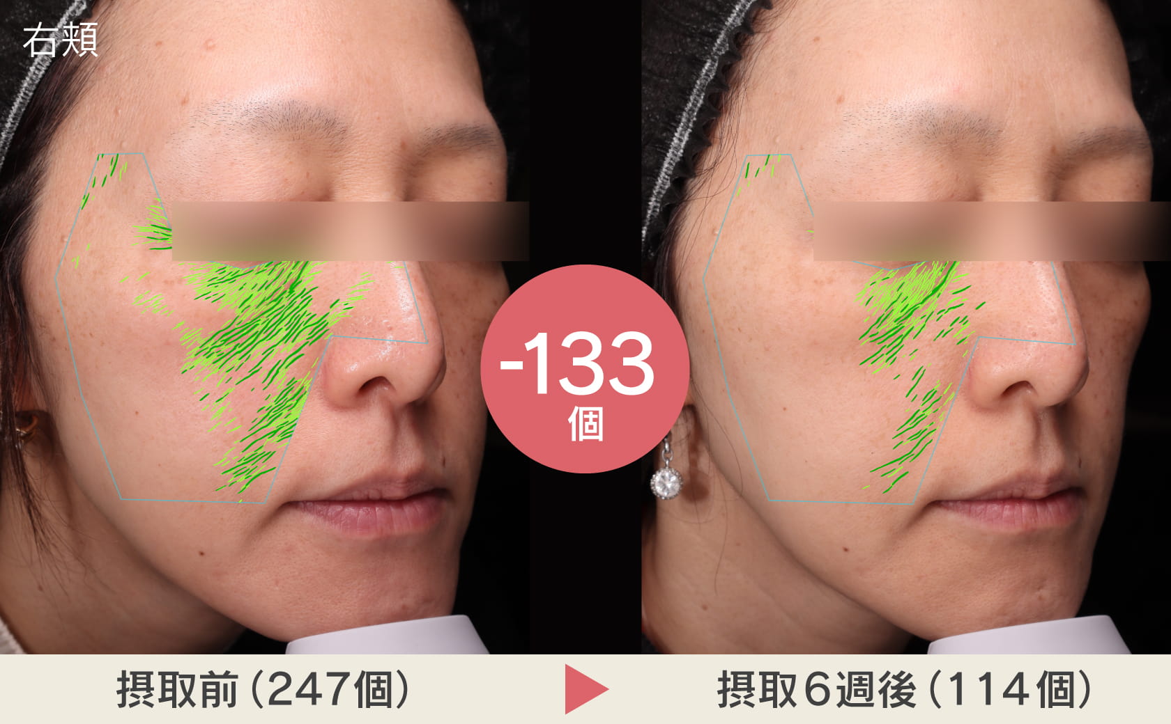 右頬摂取前と摂取後のシワの写真