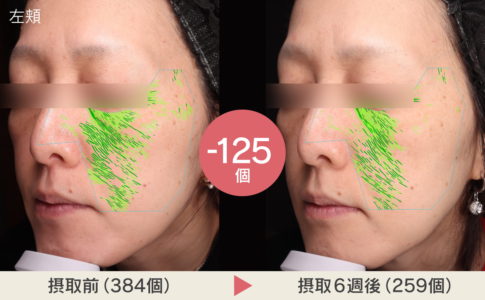 左頬摂取前と摂取後のシワの写真