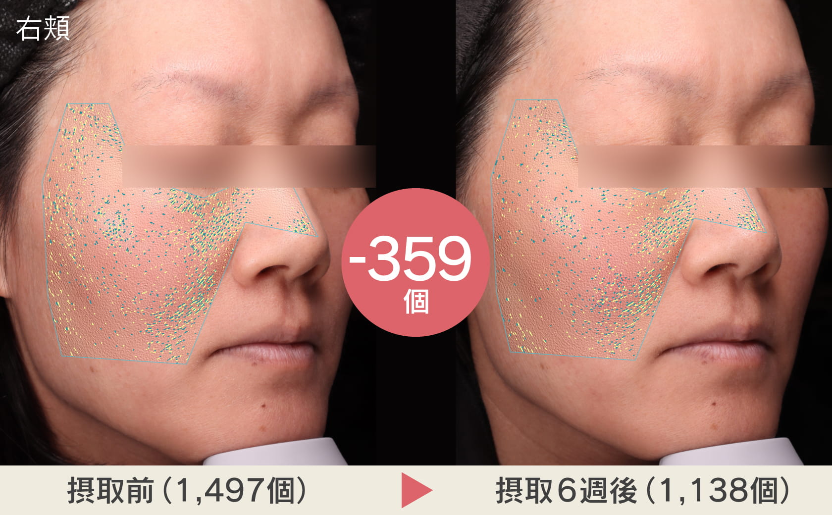 右頬摂取前と摂取後の肌表面の凹凸の写真