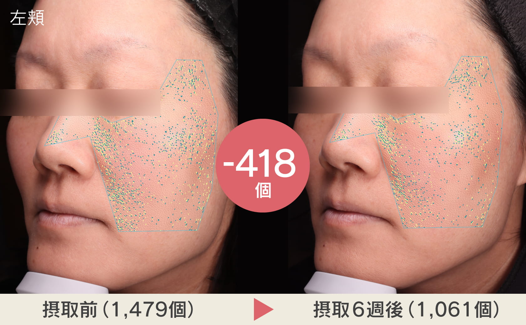 左頬摂取前と摂取後の肌表面の凹凸の写真