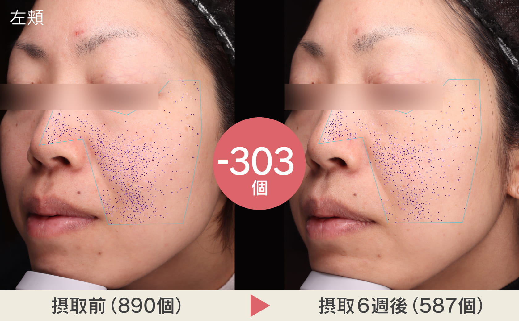 左頬摂取前と摂取後の毛穴の写真