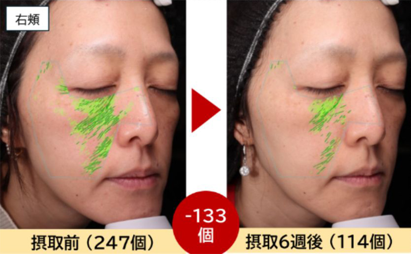 右頬摂取前と摂取後のシワの写真