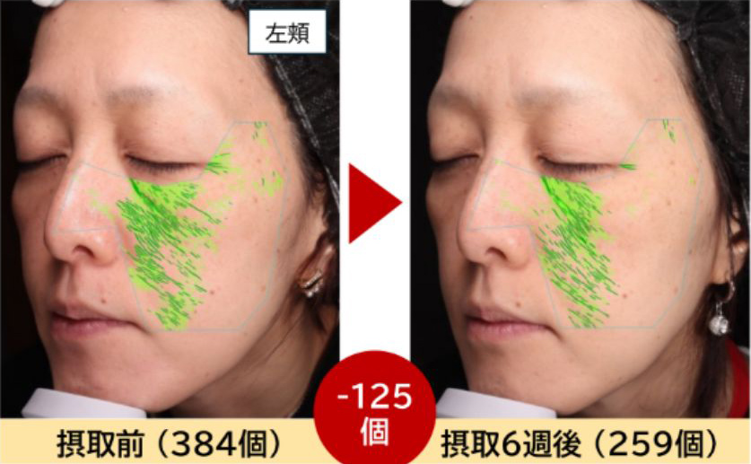 左頬摂取前と摂取後のシワの写真