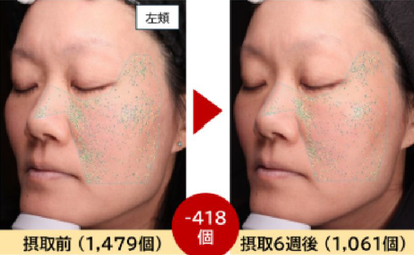 左頬摂取前と摂取後の肌表面の凹凸の写真2