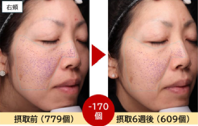 右頬摂取前と摂取後の写真3