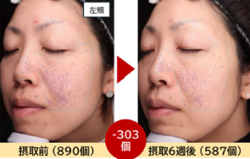 左頬摂取前と摂取後の写真3